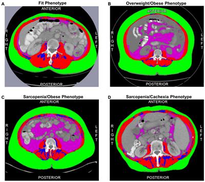 Clinically relevant body composition phenotypes are associated with distinct circulating cytokine and metabolomic milieus in epithelial ovarian cancer patients